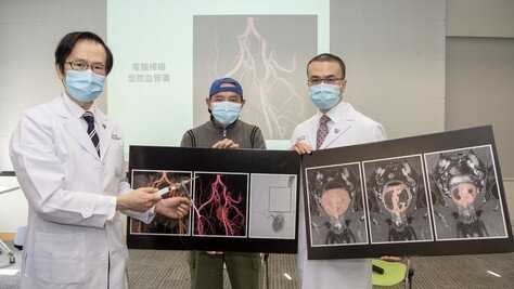 CUHK Identifies Outcome Indicators for Benign Prostatic Hyperplasia Patients Receiving Prostatic Artery Embolisation