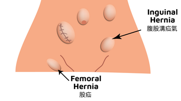 Inguinal Hernia