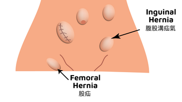 Femoral Hernia