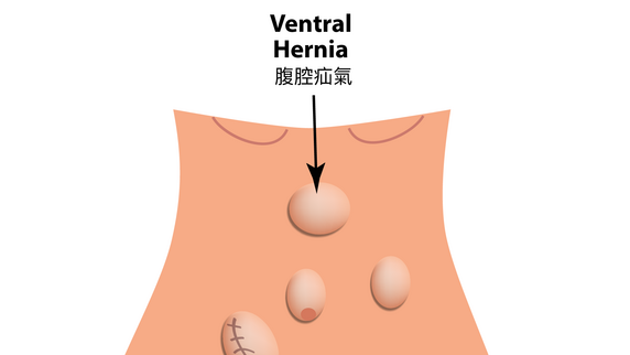 Ventral Hernia