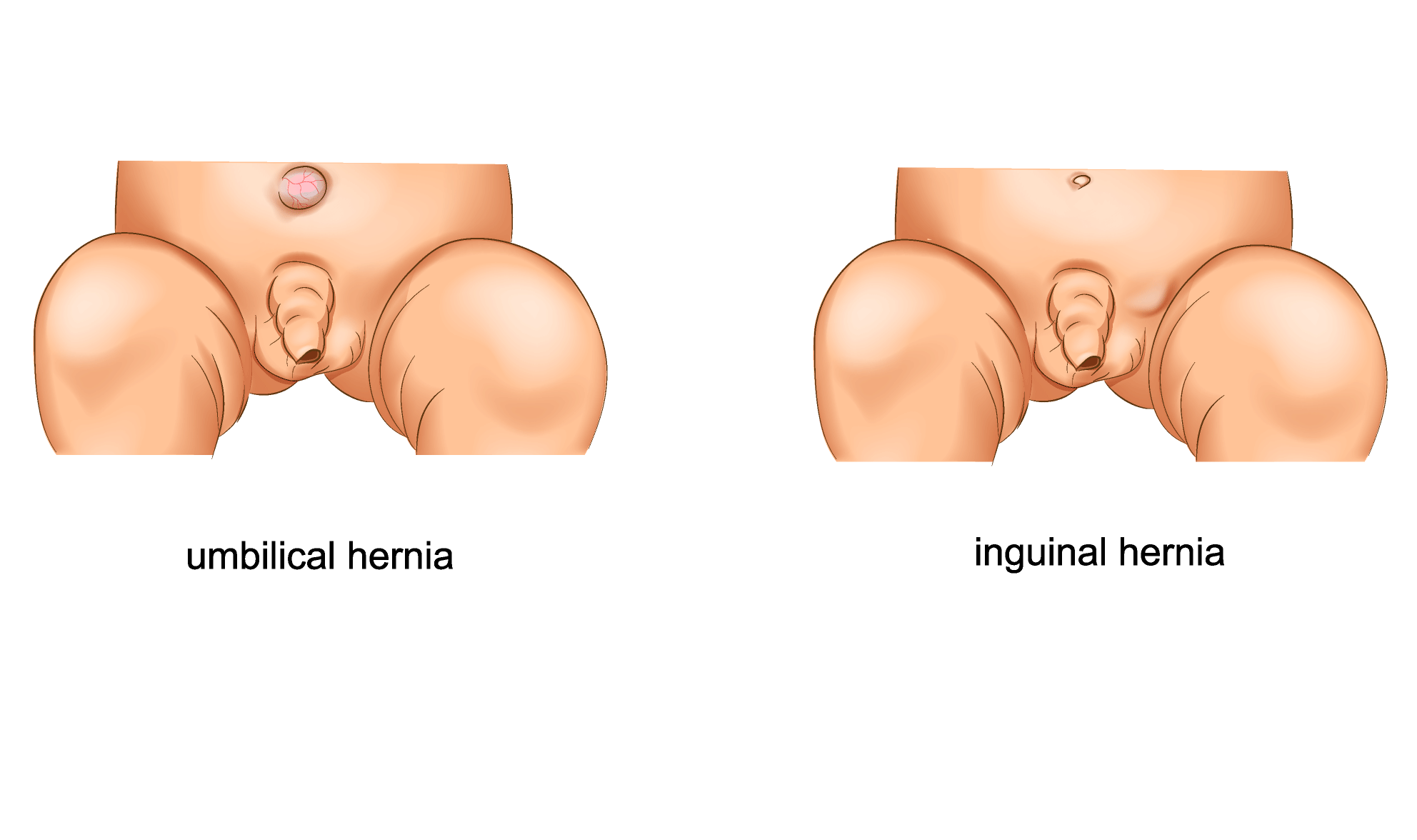 Large umbilical hernia in premature newborn baby Stock Photo