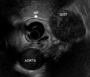 Gastrointestinal stromal tumor