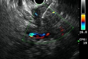 Pancreases