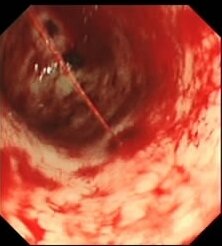 Acute upper gastrointestinal bleeding