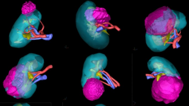 Renal Cancer Treatment