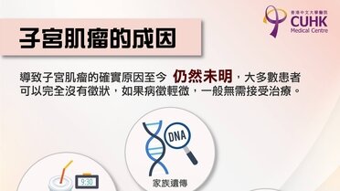 子宮肌瘤的成因 (Only available in Chinese)