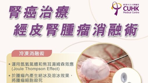 腎癌治療 - 經皮腎腫瘤消融術治療 (Only available in Chinese)