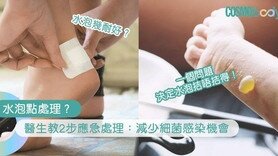 水泡处理｜不要乱刺穿！医生教2步应急处理：减少细菌感染机会好得更快！