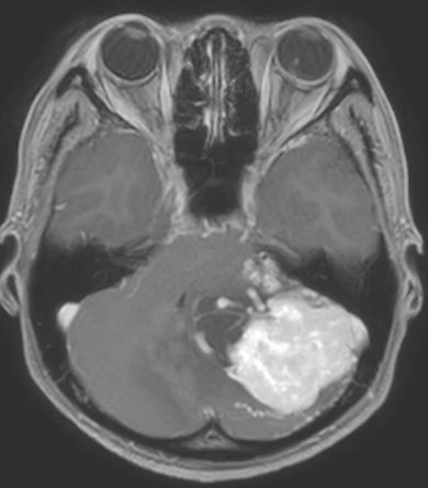Image of MR Perfusion 腦血流灌注造影相片