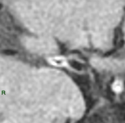 Image of Vessel Wall Imaging 血管壁造影相片