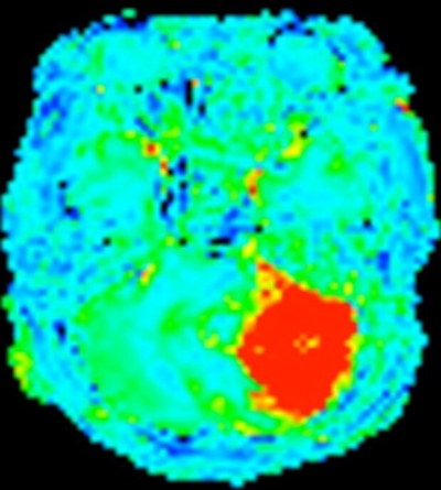 Image of MR Perfusion 腦血流灌注造影相片