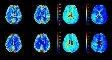 Image of MR Perfusion 腦血流灌注造影相片