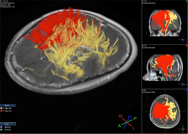Image of MR Diffusion Tensor Imaging and Tractography 磁力共振擴散張量造影 (DTI)相片
