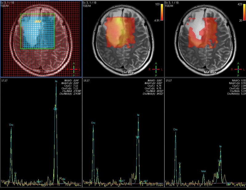 Image of MR Spectroscopy 磁力共振頻譜造影相片