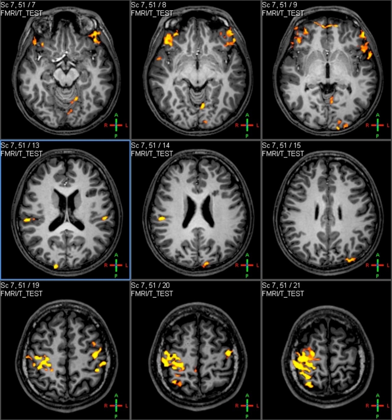 Image of Functional MRI 功能性磁力共振造影 (fMRI)相片