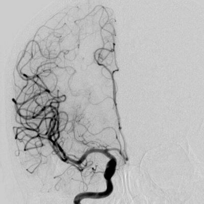 Image of Catheter cerebral angiogram 腦血管導管造影相片