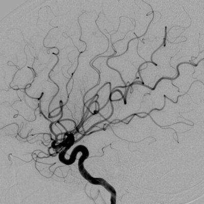 Image of Catheter cerebral angiogram 腦血管導管造影相片