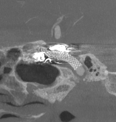 Image of Intravenous cone beam CT angiogram 錐狀射束電腦斷層掃描相片