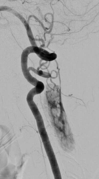 Image of Catheter spinal angiogram 脊椎血管導管造影相片