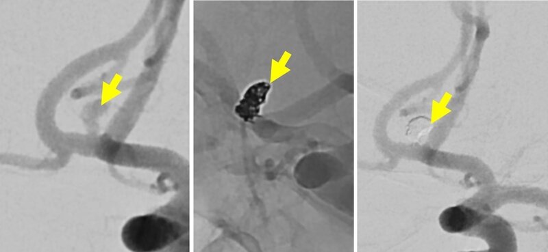 Image of Embolisation of intracranial aneurysm 顱內動脈瘤栓塞相片