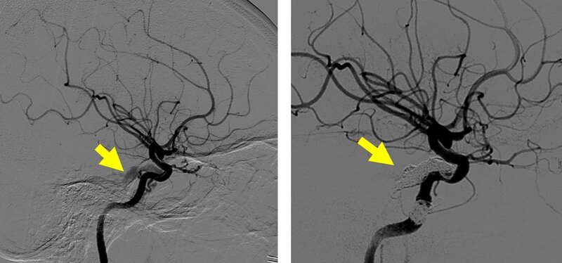 "Image of Embolisation of intracranial dissection & Embolisation of carotid-cavernous fistula 顱內血管撕裂栓塞 & 頸動脈海綿竇瘻管栓塞相片"