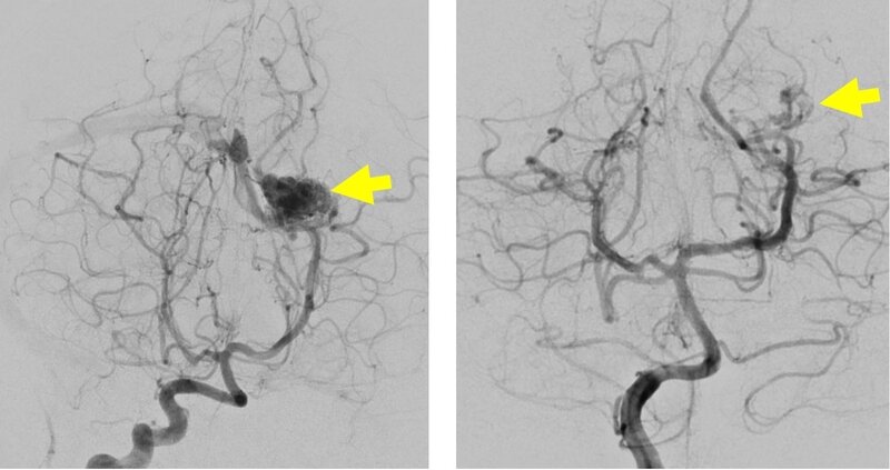 Image of Embolisation of intracranial arteriovenous malformation / fistula 顱內血管畸形 / 瘻管栓塞相片