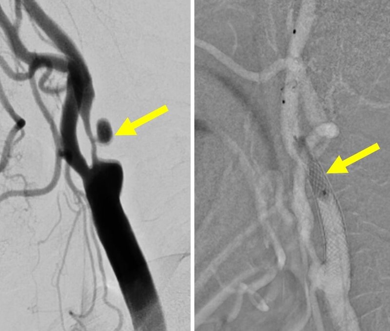 Image of Revascularisation 血管重整相片