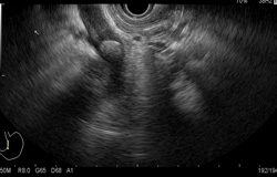 Image of Endoscopic ultrasound (EUS-gastric tract and stomach) 超聲波內視鏡（食道及胃）相片