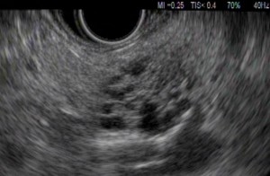 Image of Pancreatic cystic neoplasm 胰臟炎相片