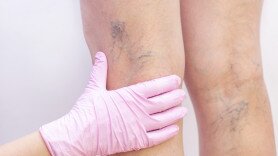 Varicose Veins Clinic